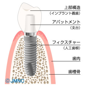 インプラント