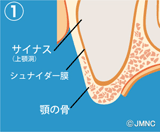 サイナスリフト法