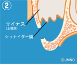 サイナスリフト法