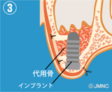 サイナスリフト法