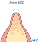 スプリットクレスト法